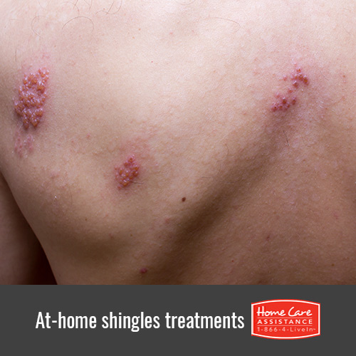 Easy At-Home Treatments to Relieve Shingles in Dallas, TX